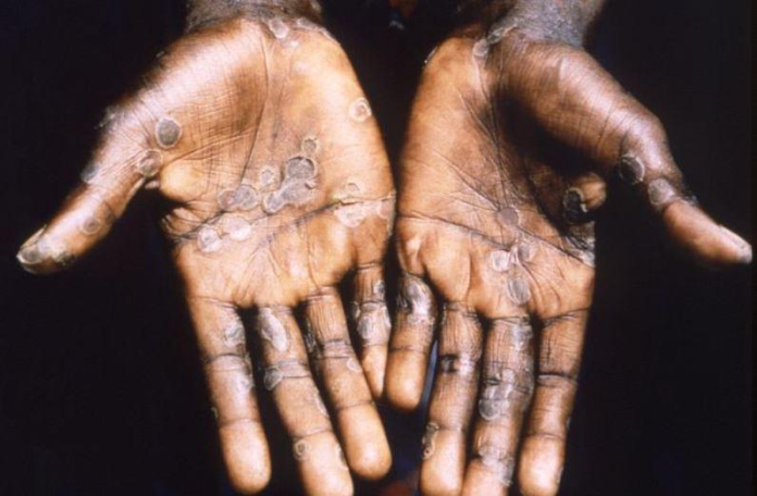 Monkeypox is a symptom of something more worrying: pandemics are going to be more and more frequent

