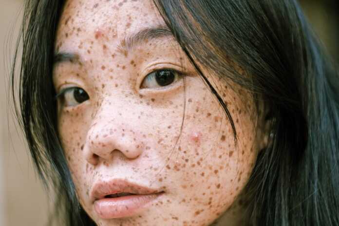  Nobody is born with freckles.  The science behind these characteristic stains
